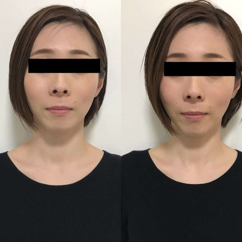 小顔矯正